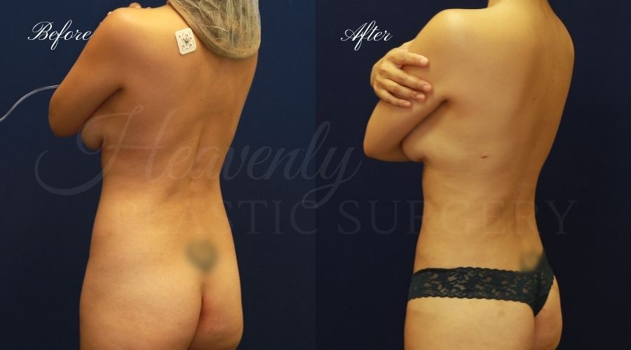 Liposuction 360, liposuction, lipo 360, liposuction surgeon, liposuction orange county, lipo 360 orange county, lipoetching orange county, back liposuction, stomach liposuction, liposuction before and after, lipoetching before and after, liposuction 360 before and after, liposuction results, lipoetching results