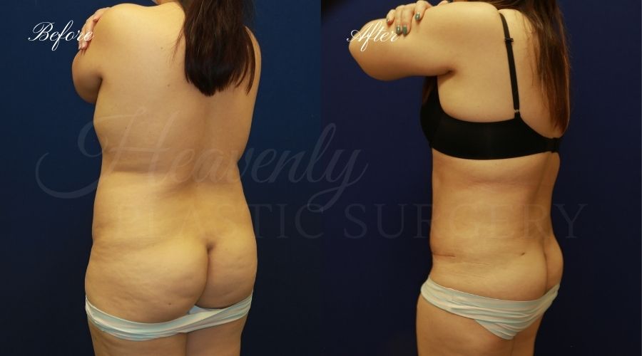 liposuction 360, lipo 360, arm liposuction, liposuction before and after, lipo 360 before and after, arm lipo before and after, chin lipo before and after, liposuction surgeon, liposuction orange county, chin lipo orange county, liposuction results, orange county plastic surgery, orange county plastic surgeon