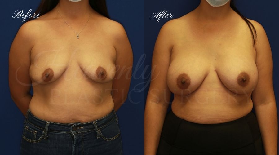 breast augmentation before and after, breast augmentation results, breast augmentation surgery, breast implants before and after, breast implants results, plastic surgery before and after, plastic surgery results, plastic surgeon, breast surgeon, breast augmentation surgeon, breast implant surgeon, breast implants orange county, breast augmentation orange county, orange county plastic surgeon, plastic surgery check