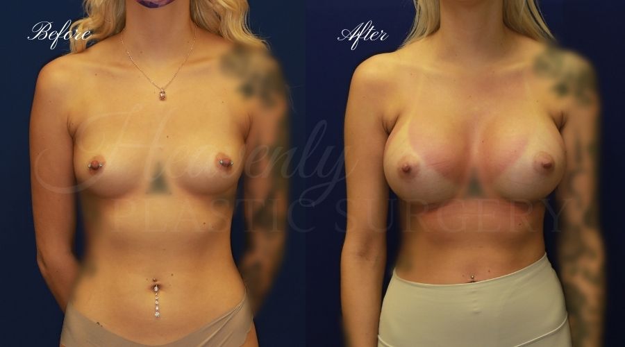 breast augmentation, breast augmentation surgery, breast augmentation surgeon, breast augmentation orange county, breast augmentation with silicone implants, sientra implants, boob job, boob job surgeon, breast implant surgeon, plastic surgery orange county, lake forest plastic surgeon, breast augmentation lake forest, south oc plastic surgeon