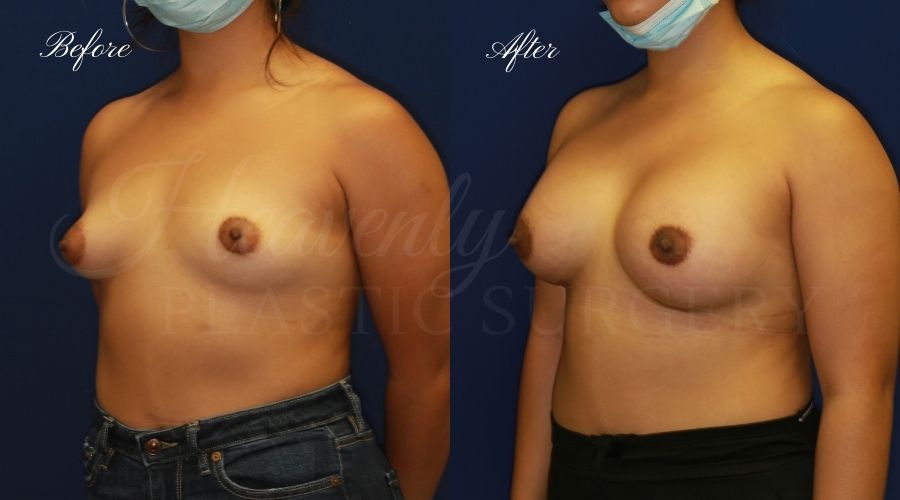 breast augmentation, breast augmentation surgery, breast augmentation surgeon, breast augmentation orange county, breast augmentation with silicone implants, sientra implants, boob job, boob job surgeon, breast implant surgeon, plastic surgery orange county, lake forest plastic surgeon, breast augmentation lake forest, south oc plastic surgeon