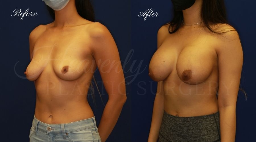 breast augmentation, breast augmentation surgery, breast augmentation surgeon, breast augmentation orange county, breast augmentation with silicone implants, sientra implants, boob job, boob job surgeon, breast implant surgeon, plastic surgery orange county, lake forest plastic surgeon, breast augmentation lake forest, south oc plastic surgeon