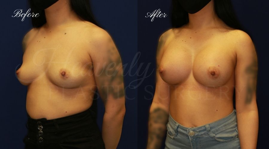 breast augmentation, breast augmentation surgery, breast augmentation surgeon, breast augmentation orange county, breast augmentation with silicone implants, sientra implants, boob job, boob job surgeon, breast implant surgeon, plastic surgery orange county, lake forest plastic surgeon, breast augmentation lake forest, south oc plastic surgeon