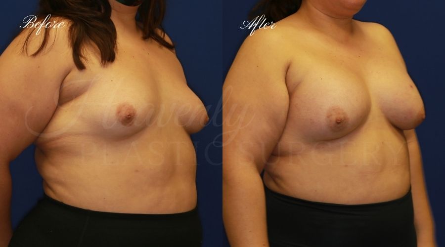 Breast Augmentation 605cc Before and After, plastic surgeon, plastic surgery, breast augmentation, enhanced breasts, boob job, implants, silicone implants