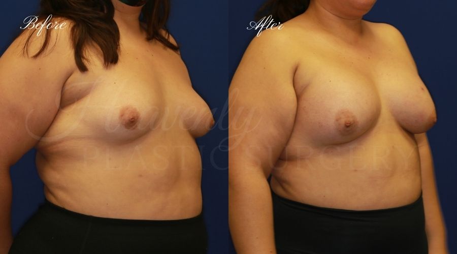 Breast Augmentation 605cc Before and After, plastic surgeon, plastic surgery, breast augmentation, enhanced breasts, boob job, implants, silicone implants Breast Augmentation 605cc Before and After, plastic surgeon, plastic surgery, breast augmentation, enhanced breasts, boob job, implants, silicone implants