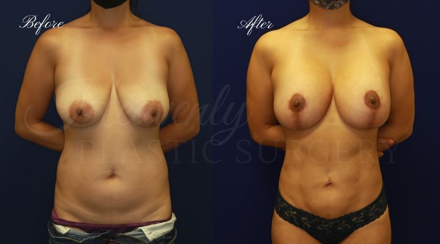 Breast Lift with Implants Before and After, Mastopexy Augmentation (Breast Implants with Lift) - 310cc SRM Silicone breast implants with Wise-pattern breast lift (Anchor scar), plastic surgery