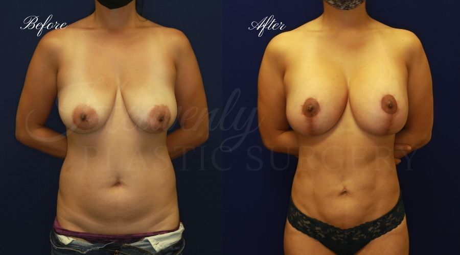 Breast Lift with Implants Before and After, Mastopexy Augmentation (Breast Implants with Lift) - 310cc SRM Silicone breast implants with Wise-pattern breast lift (Anchor scar), plastic surgery Breast Lift with Implants Before and After, Mastopexy Augmentation (Breast Implants with Lift) - 310cc SRM Silicone breast implants with Wise-pattern breast lift (Anchor scar), plastic surgery