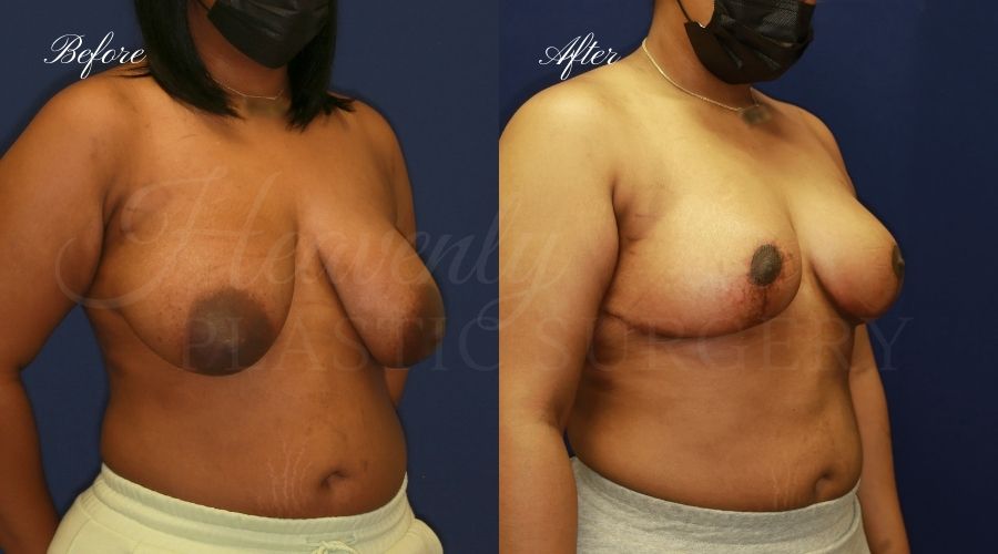 Breast lift surgery, breast lift, breast lift surgeon, mastopexy, mastopexy surgery, breast lift without implants, breast lift orange county, plastic surgery before and after, breast lift before and after, breast lift results, breast reduction, breast reduction results, plastic surgeon, plastic surgery, orange county plastic surgery, orange county plastic surgeon Breast lift surgery, breast lift, breast lift surgeon, mastopexy, mastopexy surgery, breast lift without implants, breast lift orange county, plastic surgery before and after, breast lift before and after, breast lift results, breast reduction, breast reduction results, plastic surgeon, plastic surgery, orange county plastic surgery, orange county plastic surgeon