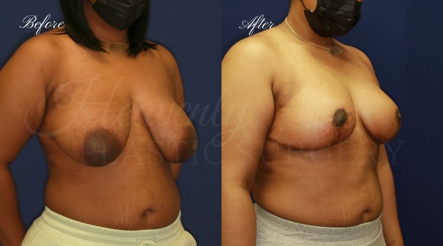 Breast lift surgery, breast lift, breast lift surgeon, mastopexy, mastopexy surgery, breast lift without implants, breast lift orange county, plastic surgery before and after, breast lift before and after, breast lift results, breast reduction, breast reduction results, plastic surgeon, plastic surgery, orange county plastic surgery, orange county plastic surgeon