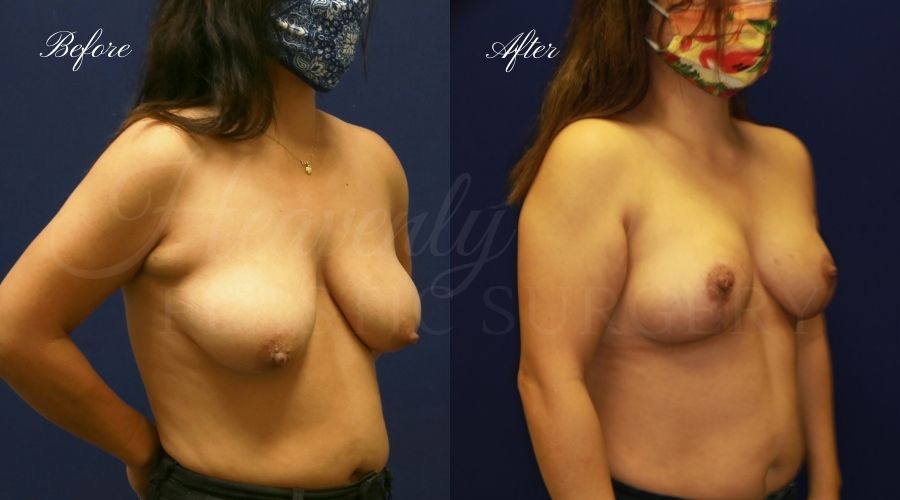 Breast lift surgery, breast lift, breast lift surgeon, mastopexy, mastopexy surgery, breast lift without implants, breast lift orange county, plastic surgery before and after, breast lift before and after, breast lift results, breast reduction, breast reduction results, plastic surgeon, plastic surgery, orange county plastic surgery, orange county plastic surgeon