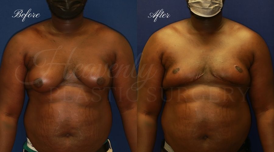 Plastic surgery, plastic surgeon, gynecomastia excision, man boobs