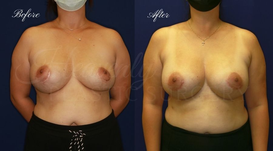 Plastic surgery, plastic surgeon, breast surgery, breast implant revision, deflated breast implant, breast augmentation correction, implant exchange, breast implants, implant exchange, breast implant exchange