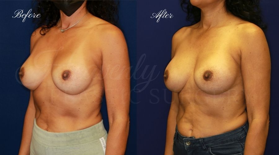 Plastic surgery, plastic surgeon, breast surgery, breast implant revision, deflated breast implant, breast augmentation correction, implant exchange, breast implants, implant exchange, breast implant exchange