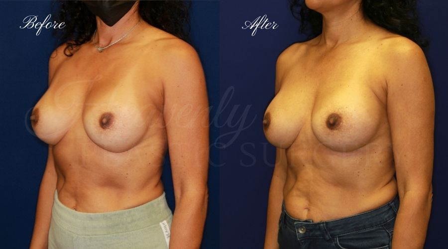 Plastic surgery, plastic surgeon, breast surgery, breast implant revision, deflated breast implant, breast augmentation correction, implant exchange, breast implants, implant exchange, breast implant exchange Plastic surgery, plastic surgeon, breast surgery, breast implant revision, deflated breast implant, breast augmentation correction, implant exchange, breast implants, implant exchange, breast implant exchange