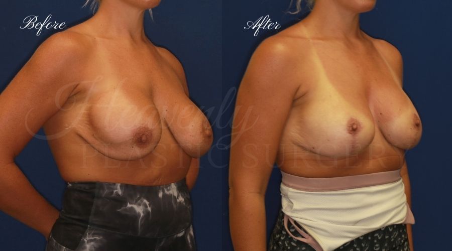 Breast Implant Exchange and Breast Lift - 310cc SRM Silicone Implants with Wise pattern Mastopexy (Anchor Scar)