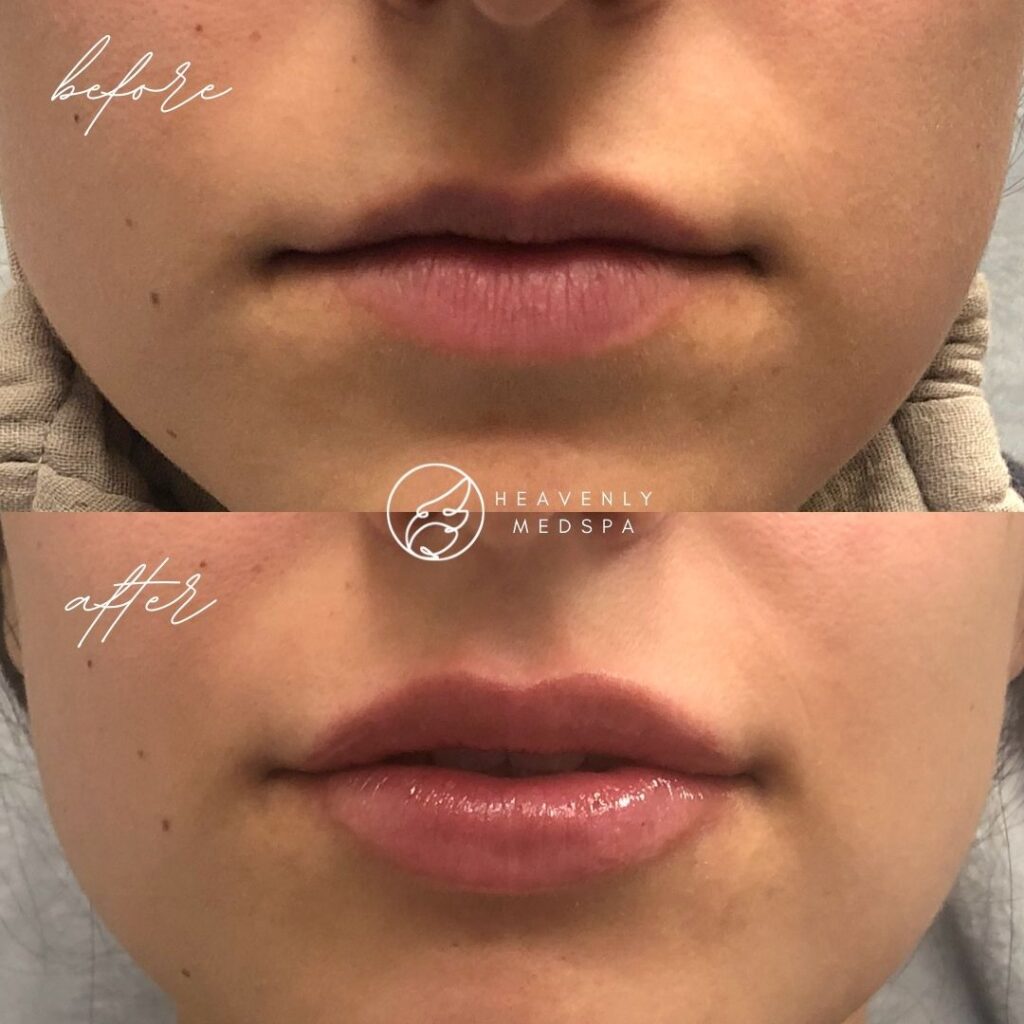 lip filler, dermal filler, lip filler orange county, lip filler foothill ranch, lip filler lake forest, nurse injector, medspa, medspa lake forest, lip filler medspa, lip filler before and after, revanesse versa, versa before and after, lip filler before and after