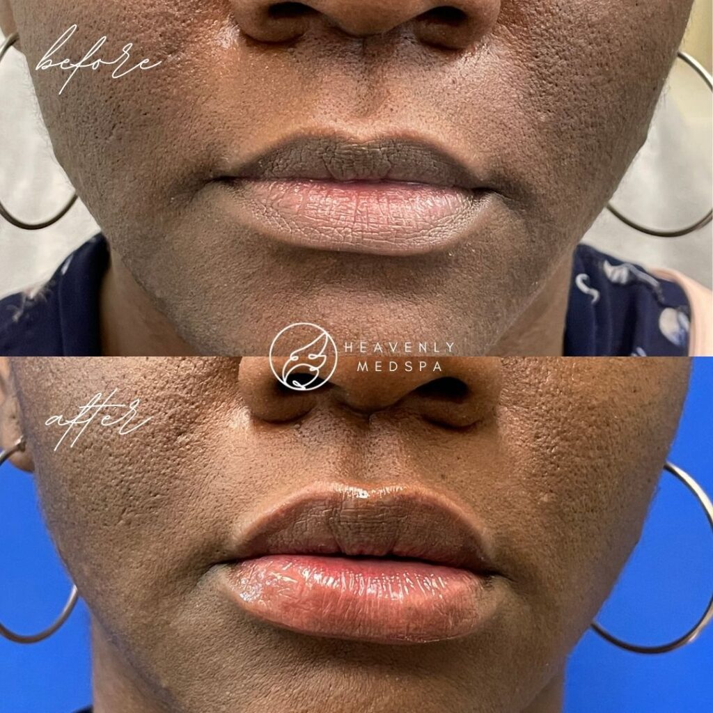 lip filler, dermal filler, lip filler orange county, lip filler foothill ranch, lip filler lake forest, nurse injector, medspa, medspa lake forest, lip filler medspa, lip filler before and after, revanesse versa, versa before and after, lip filler before and after