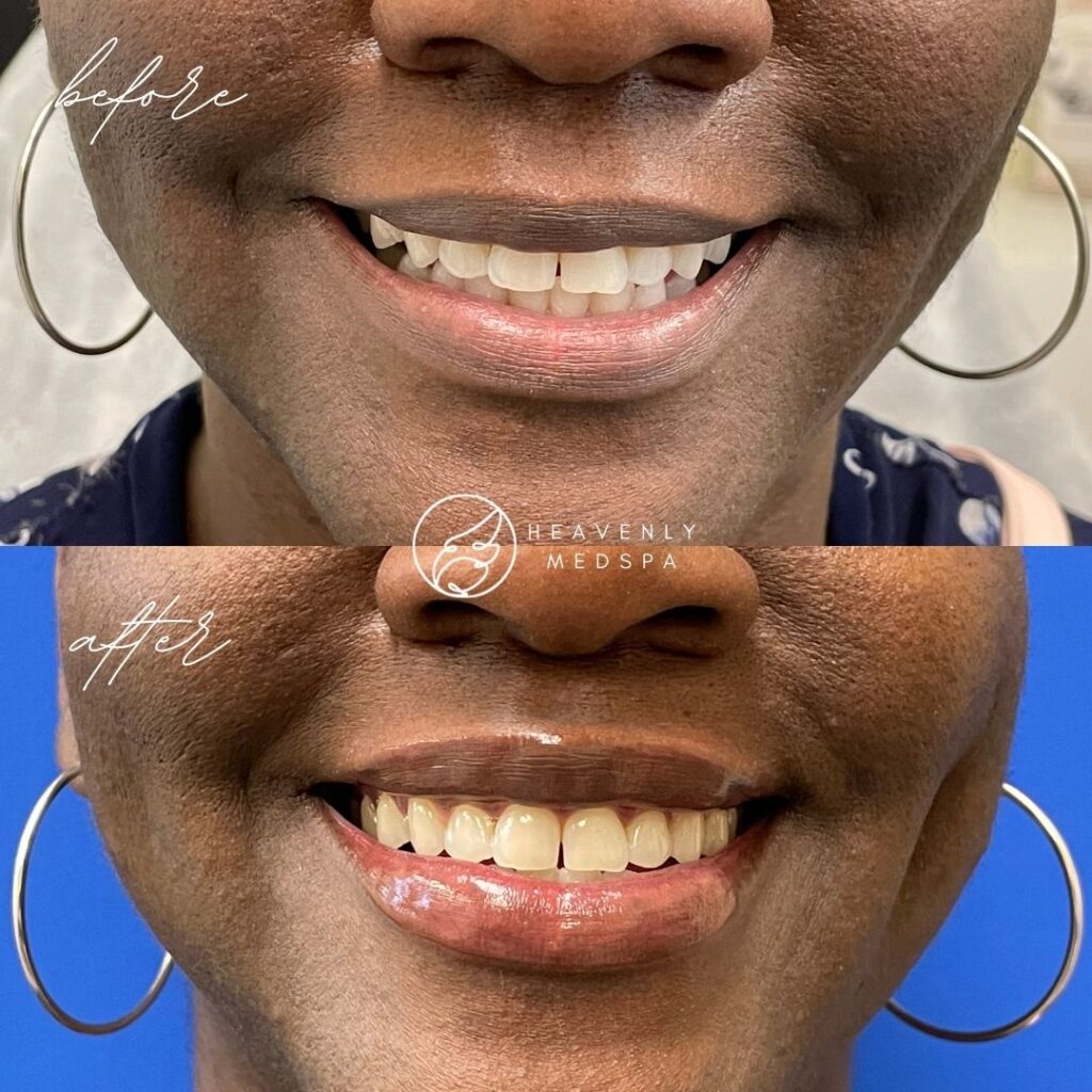 lip filler, dermal filler, lip filler orange county, lip filler foothill ranch, lip filler lake forest, nurse injector, medspa, medspa lake forest, lip filler medspa, lip filler before and after, revanesse versa, versa before and after, lip filler before and after