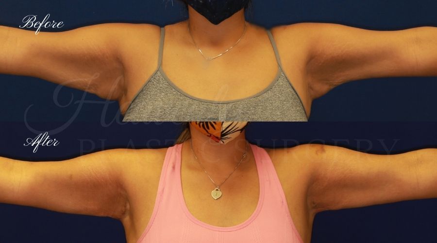 arm lift, extra arm skin, flabby arms, brachioplasty, before and after arm lift, plastic surgery, plastic surgeon, arm lift specialist, arm lift expert