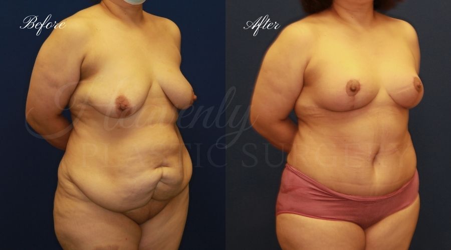 Mommy makeover before and after, mommy makeover surgery, breast lift surgery, tummy tuck surgery, breast lift before and after, tummy tuck before and after, mommy makeover surgeon, mommy makeover surgery, mommy makeover orange county, tummy tuck orange county, breast lift orange county, plastic surgery, plastic surgeon, plastic surgery before and after, mommy makeover journey, mommy makeover results, tummy tuck journey, tummy tuck results, plastic surgery results, orange county plastic surgeon, orange county plastic surgery, plastic surgery orange county Mommy makeover before and after, mommy makeover surgery, breast lift surgery, tummy tuck surgery, breast lift before and after, tummy tuck before and after, mommy makeover surgeon, mommy makeover surgery, mommy makeover orange county, tummy tuck orange county, breast lift orange county, plastic surgery, plastic surgeon, plastic surgery before and after, mommy makeover journey, mommy makeover results, tummy tuck journey, tummy tuck results, plastic surgery results, orange county plastic surgeon, orange county plastic surgery, plastic surgery orange county