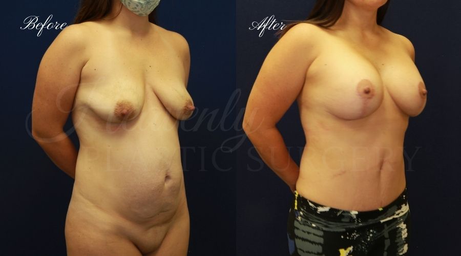 Mommy Makeover - Breast Augmentation, Breast Lift, Tummy Tuck, Liposuction