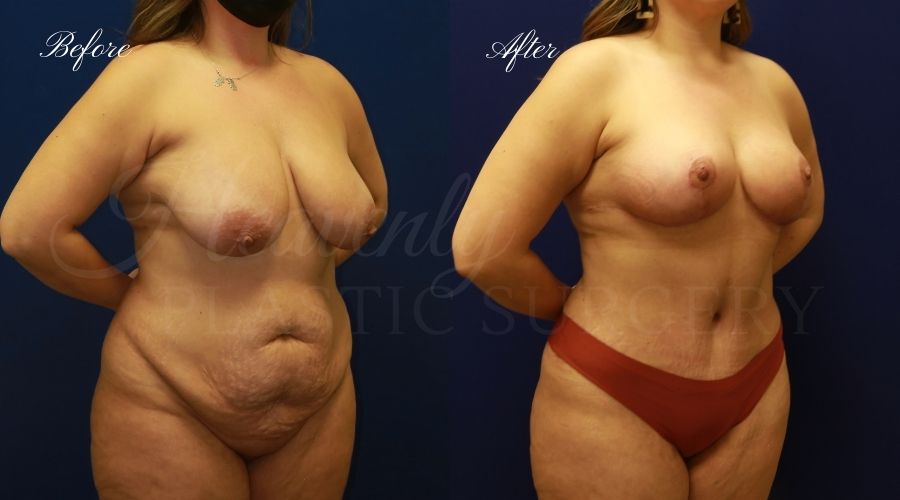 Heavenly Plastic Surgery, Plastic Surgery, Plastic Surgeon, Breast Reduction, Breast Surgery, Breast Lift, Tummy Tuck, Tummy Tuck with liposuction, Tummy Tuck with Lipo, Liposuction, Lipo, macromastia, large breast surgery, enlarged breast surgery