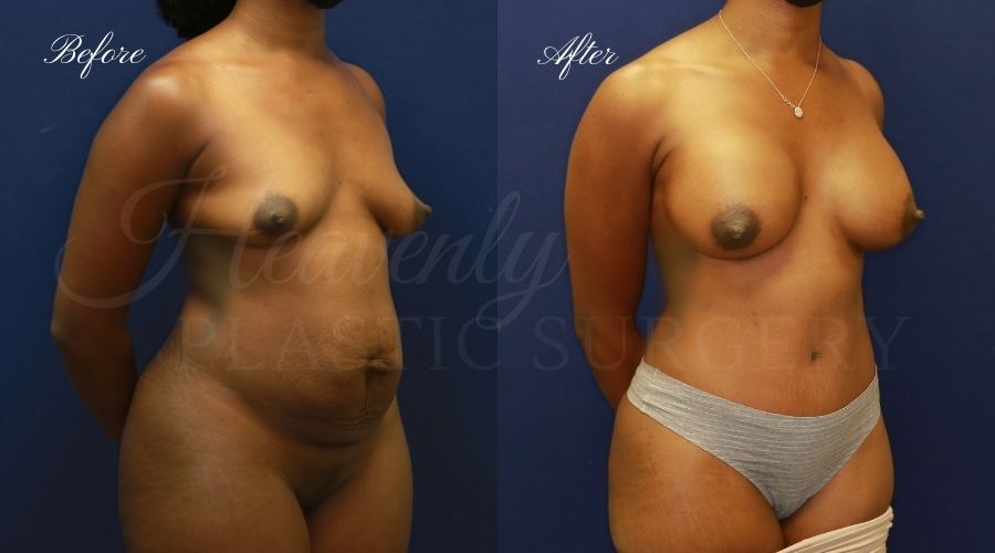 Heavenly Plastic Surgery, Plastic Surgery, Plastic Surgeon, Mommy Makeover, Transformation, Breast Lift, Tummy Tuck, Breast lift without implants, Breast Surgery, Body Surgery, Tummy Tuck, Tummy Tuck with Liposuction, Liposuction