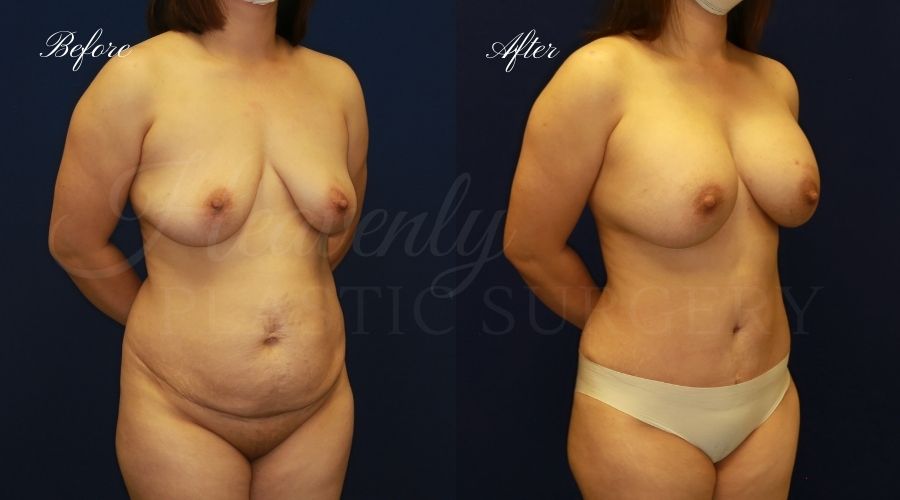 Mommy Makeover - Implant Exchange + Tummy Tuck Before and After, Mommy Makeover Orange County, Mommy Makeover Surgeon, Mommy Makeover Surgery
