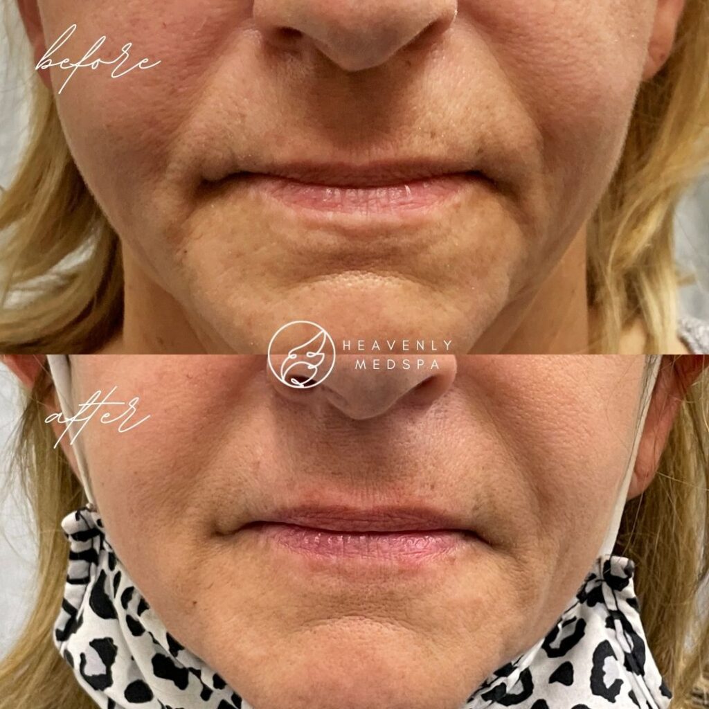 plastic surgery, plastic surgeon, nasolabial folds, laugh lines, laugh line fillers, nasolabial fold fillers, nasolabial fillers, hyaluronic acid, fillers, injectables, liquid facelift