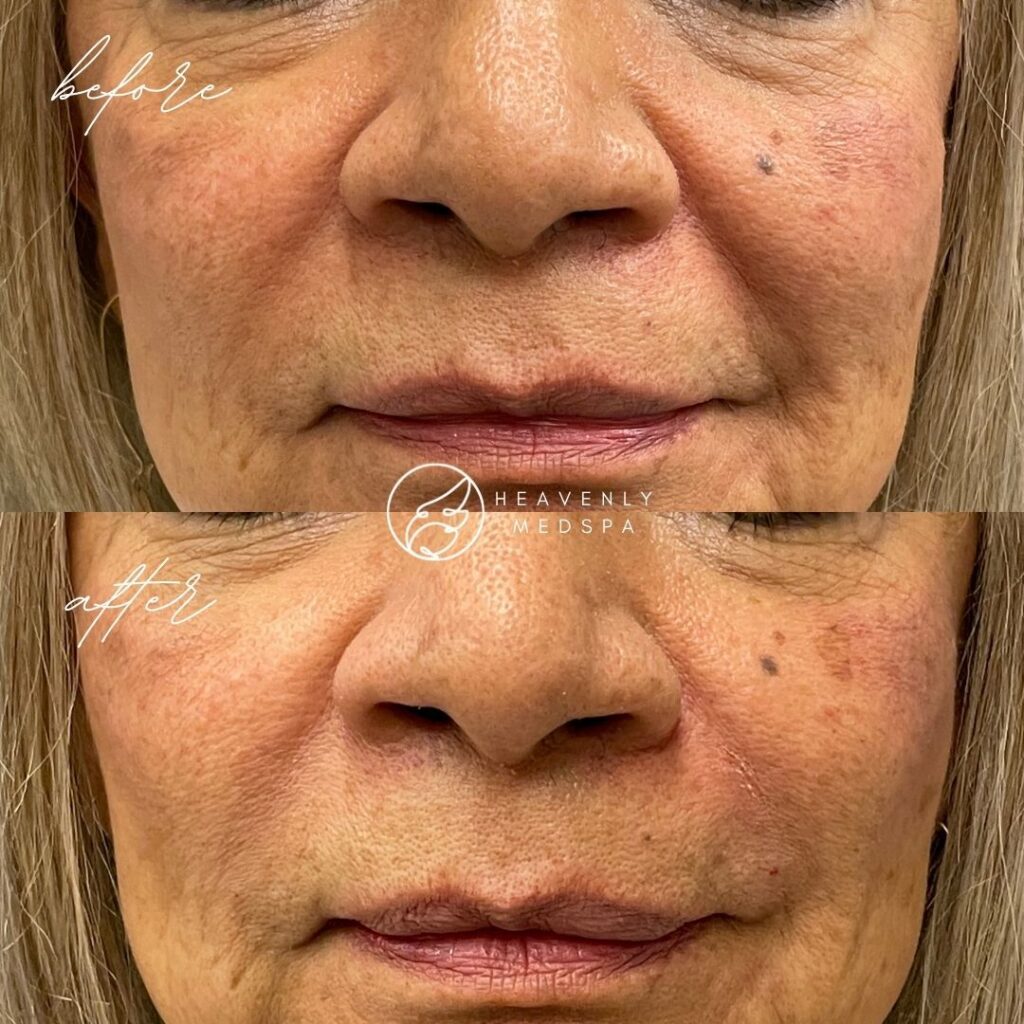 plastic surgery, plastic surgeon, nasolabial folds, laugh lines, laugh line fillers, nasolabial fold fillers, nasolabial fillers, hyaluronic acid, fillers, injectables, liquid facelift plastic surgery, plastic surgeon, nasolabial folds, laugh lines, laugh line fillers, nasolabial fold fillers, nasolabial fillers, hyaluronic acid, fillers, injectables, liquid facelift