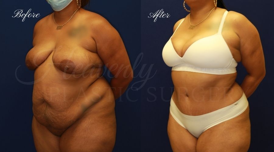tummy tuck before and after, liposuction before and after, tummy tuck with liposuction, liposuction before and after, tummy tuck orange county, liposuction orange county, lipoetching tummy tuck before and after, liposuction before and after, tummy tuck with liposuction, liposuction before and after, tummy tuck orange county, liposuction orange county, lipoetching