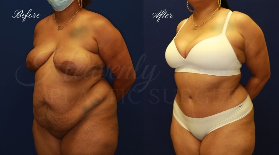 Tummy Tuck Gallery - Heavenly Plastic Surgery