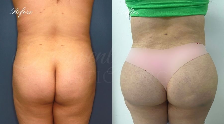 BBL Orange county, brazilian butt lift orange county, brazilian butt lift before and after, brazilian butt lift surgeon, brazilian butt lift results, bbl surgeon, bbl results, bbl before and after, fat transfer to the butt, butt augmentation, butt augmentation surgery, butt augmentation surgeon