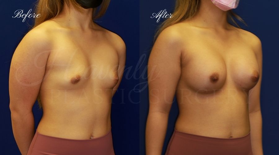 breast augmentation, breast augmentation surgery, breast augmentation surgeon, breast augmentation orange county, breast augmentation with silicone implants, sientra implants, boob job, boob job surgeon, breast implant surgeon, plastic surgery orange county, lake forest plastic surgeon, breast augmentation lake forest, south oc plastic surgeon