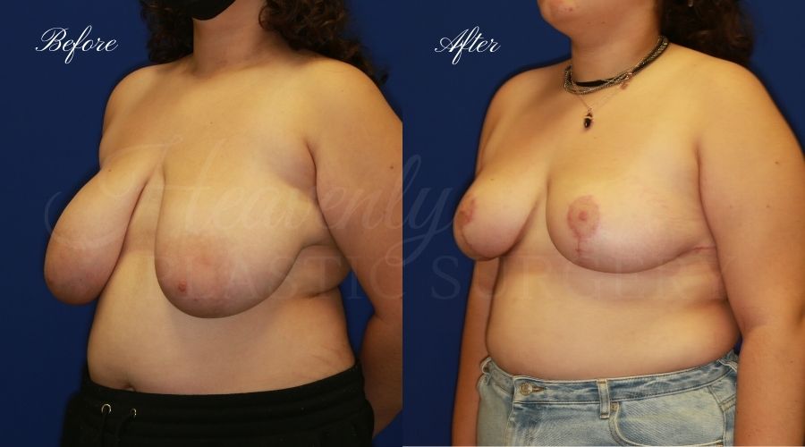 Plastic surgery, plastic surgeon, breast reduction, breast lift, reduction mammaplasty, mastopexy, before and after