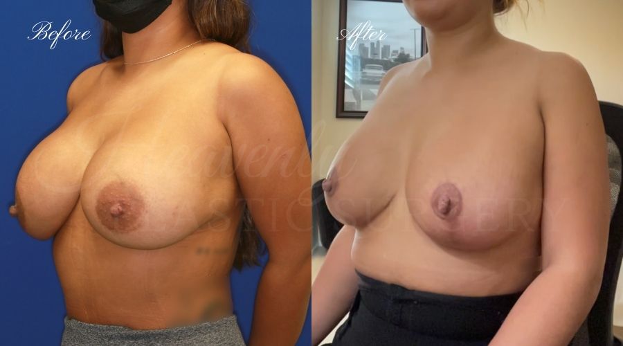 Breast Implant Exchange and Breast Lift - 310cc SRM Silicone Implants with Wise pattern Mastopexy (Anchor Scar) Breast Implant Exchange and Breast Lift - 310cc SRM Silicone Implants with Wise pattern Mastopexy (Anchor Scar)