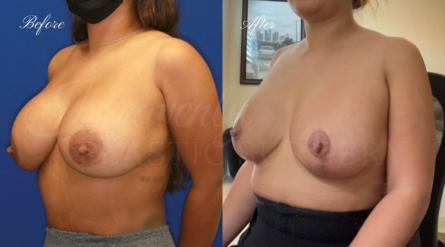 Breast Implant Exchange and Breast Lift - 310cc SRM Silicone Implants with Wise pattern Mastopexy (Anchor Scar)