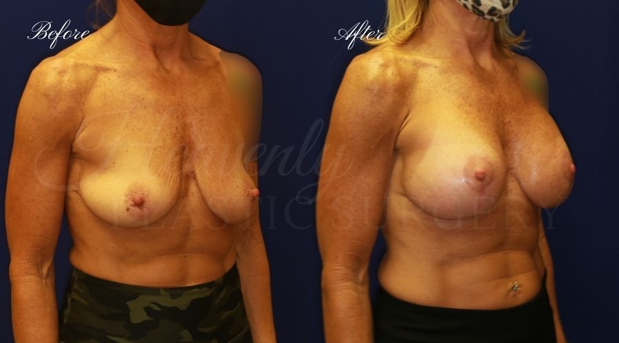 Breast Lift with Implants Before and After, Mastopexy Augmentation (Breast Implants with Lift) - 310cc SRM Silicone breast implants with Wise-pattern breast lift (Anchor scar), plastic surgery