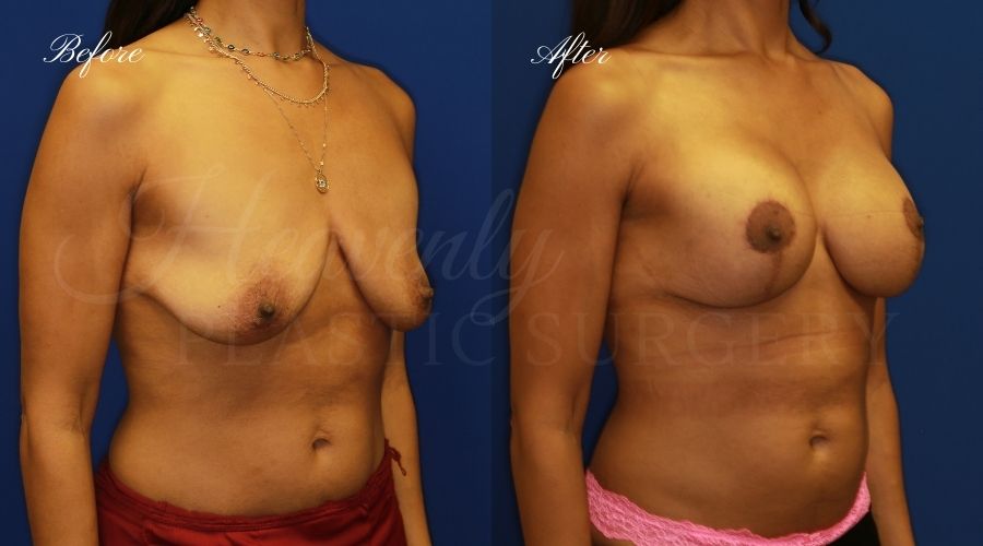 Breast Lift with Implants Before and After, Mastopexy Augmentation (Breast Implants with Lift) - 310cc SRM Silicone breast implants with Wise-pattern breast lift (Anchor scar), plastic surgery Breast Lift with Implants Before and After, Mastopexy Augmentation (Breast Implants with Lift) - 310cc SRM Silicone breast implants with Wise-pattern breast lift (Anchor scar), plastic surgery