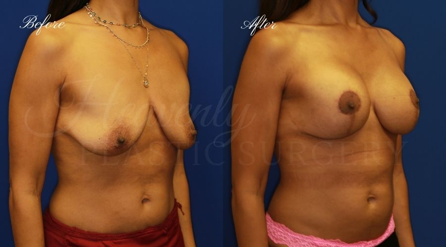 Breast Lift with Implants Before and After, Mastopexy Augmentation (Breast Implants with Lift) - 310cc SRM Silicone breast implants with Wise-pattern breast lift (Anchor scar), plastic surgery