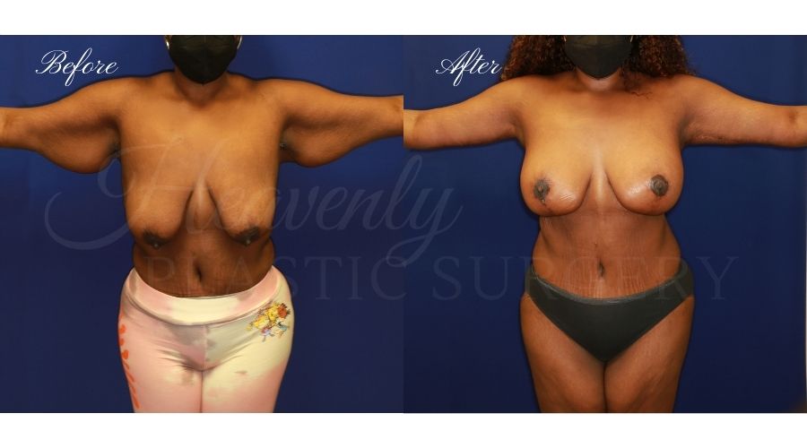 mommy makeover, mommy makeover surgeon, mommy makeover oragne county, breast lift with implants, mastopexy augmentation, breast augmentation with lift, breast surgery before and after, arm lift, arm lift surgeon, arm lift before and after, weightloss, weightloss surgery, excess skin surgery, arm lift before and after, brachioplasty before and after