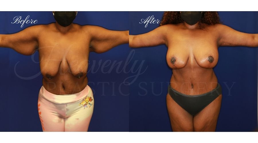 mommy makeover, mommy makeover surgeon, mommy makeover oragne county, breast lift with implants, mastopexy augmentation, breast augmentation with lift, breast surgery before and after, arm lift, arm lift surgeon, arm lift before and after, weightloss, weightloss surgery, excess skin surgery, arm lift before and after, brachioplasty before and after mommy makeover, mommy makeover surgeon, mommy makeover oragne county, breast lift with implants, mastopexy augmentation, breast augmentation with lift, breast surgery before and after, arm lift, arm lift surgeon, arm lift before and after, weightloss, weightloss surgery, excess skin surgery, arm lift before and after, brachioplasty before and after