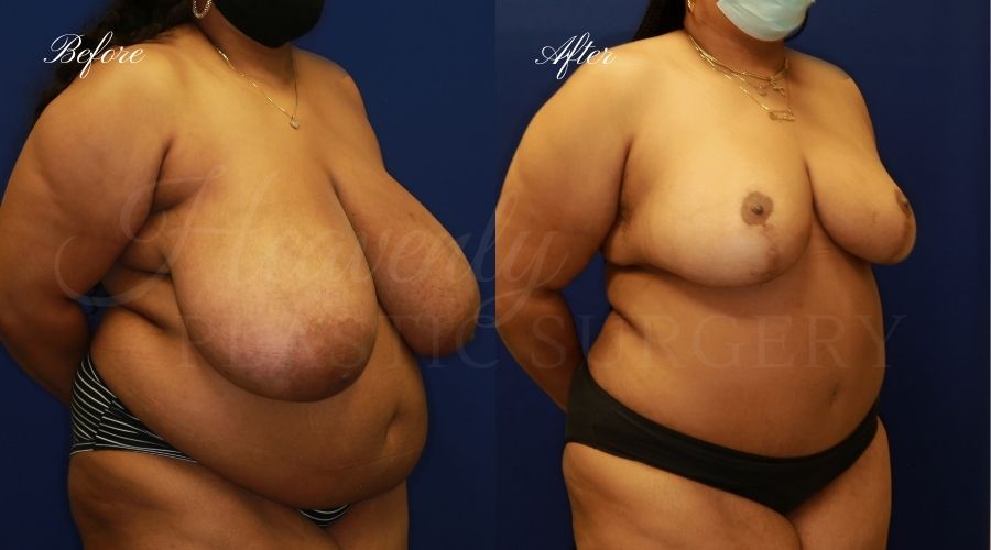 mommy makeover before and after, mommy makeover surgeon, breast reduction, breast reduction surgeon, tummy tuck, tummy tuck surgeon, tummy tuck before and after, breast reduction before and after, mammaplasty, abdominoplasty, transformation surgery, plastic surgery, plastic surgeon, orange county mommy makeover, orange county breast reduction, orange county tummy tuck