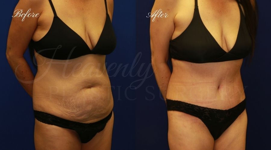 extended tummy tuck before and after, tummy tuck before and after, extended tummy tuck, large tummy tuck, plus sized tummy tuck, large tummy tuck before and after, tummy tuck surgeon, tummy tuck surgery, abdominoplasty, large abdominoplasty, weight loss surgery