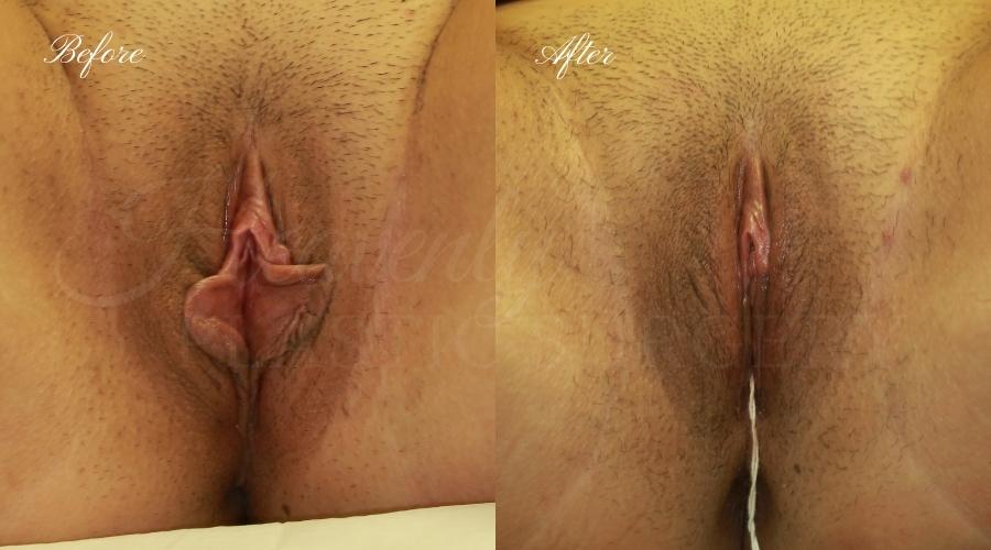 Labiaplasty, vaginal surgery, vaginal rejuvenation, vaginal reconstruction