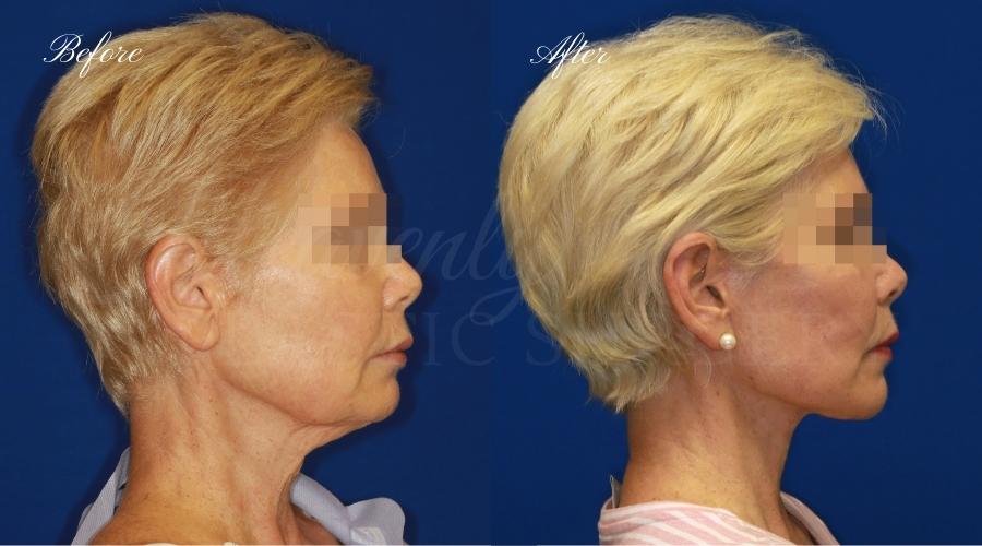 face lift, cosmetic surgery, neck lift, plastic surgery, before and after face lift, face surgery, plastic surgery