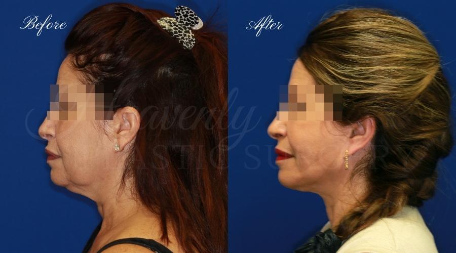 face lift, cosmetic surgery, neck lift, plastic surgery, before and after face lift, face surgery, plastic surgery