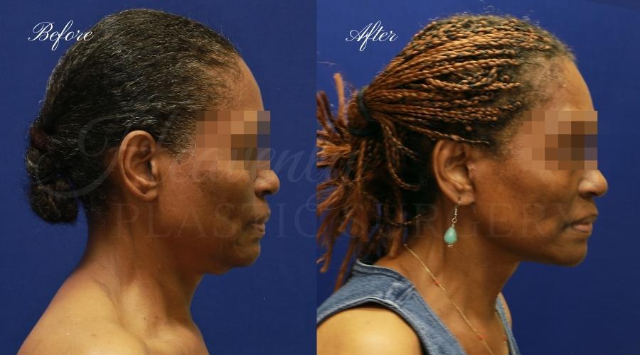 face lift, cosmetic surgery, neck lift, plastic surgery, before and after face lift, face surgery, plastic surgery, facelift, necklift, c02 laser, laser treatment, laser treatment before and after, laser skincare,