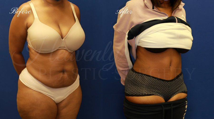extended tummy tuck before and after, tummy tuck before and after, extended tummy tuck, large tummy tuck, plus sized tummy tuck, large tummy tuck before and after, tummy tuck surgeon, tummy tuck surgery, abdominoplasty, large abdominoplasty, weight loss surgery