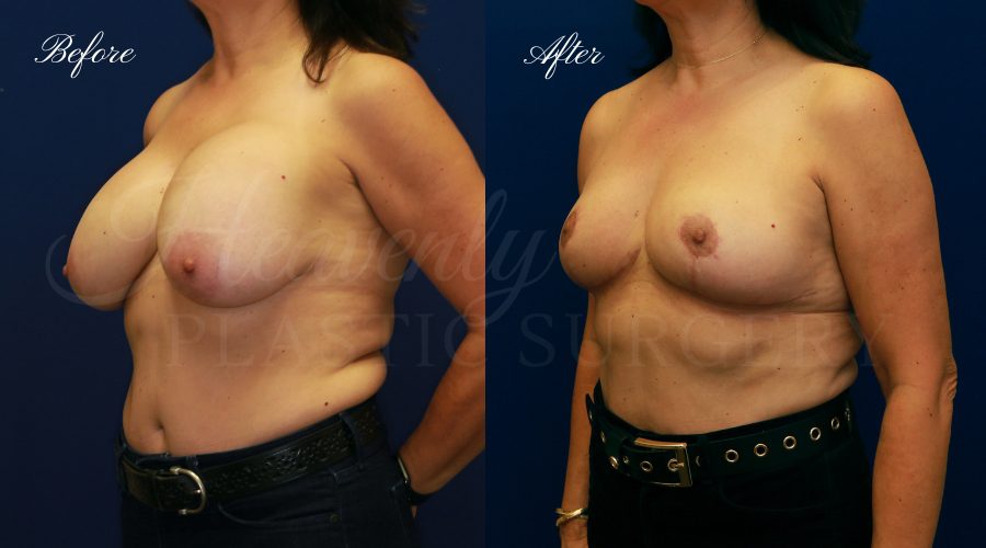 Breast Implant Removal + Breast Lift, Explant and Breast Lift, Breast Explant, Mastopexy, IMplant removal and mastopexy, plastic surgery before and after, plastic surgery revision, implant removal before and after, breast implant removal before and after, breast implant removal surgeon, breast implant removal orange county